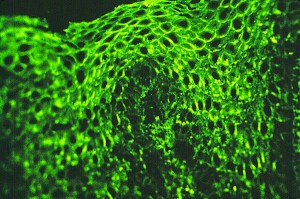 pemphigus